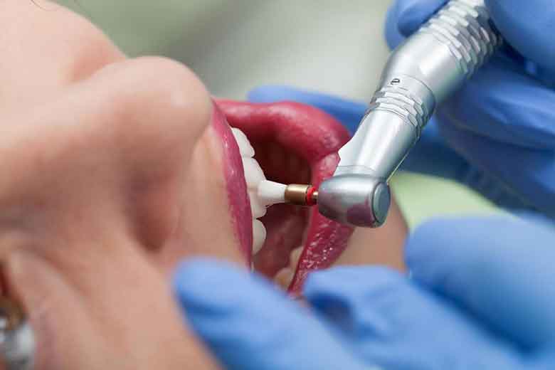 Teeth Cleaning Procedure