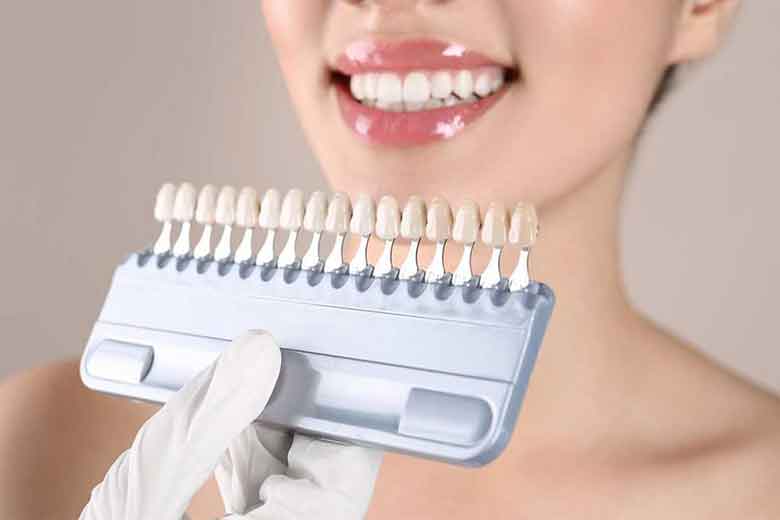 matching teeth color for smiling lady