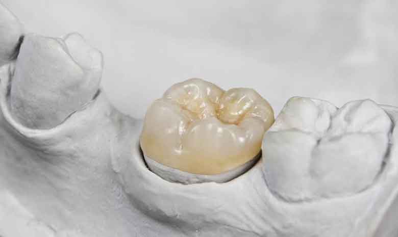 A Close-up View of Yellow Teeth in the Middle of White Teeth Needs Dental Crowns in Parker, CO