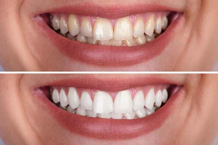 After and Before Teeth whitening image