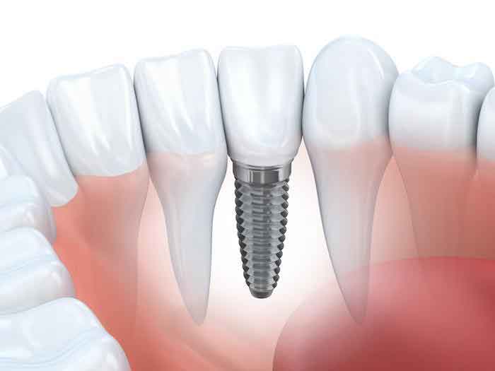 Dental Impact Treatment