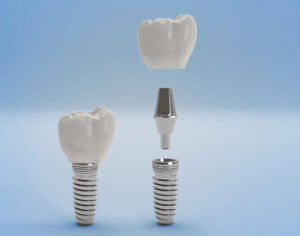 dental implant pieces on a blue background in Parker, CO