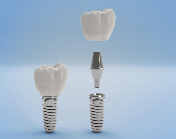 A Dentist in Parker, CO Explains Are Dental Implants Painful?