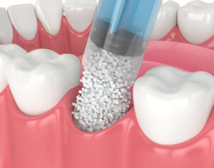 graphic of a bone graft in Parker, CO