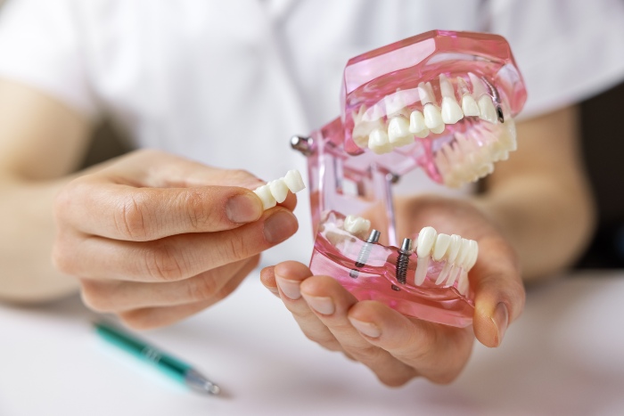 Discover the advantages of fixed implant bridges in Parker, CO