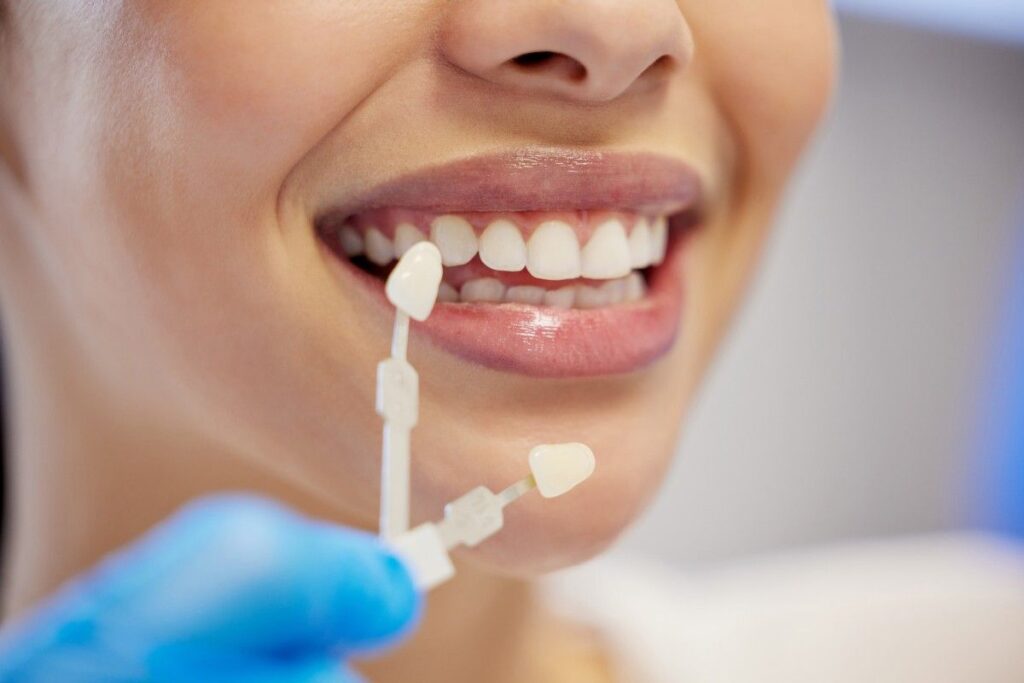 Close-up of a dental professional holding veneer samples near teeth for color matching.