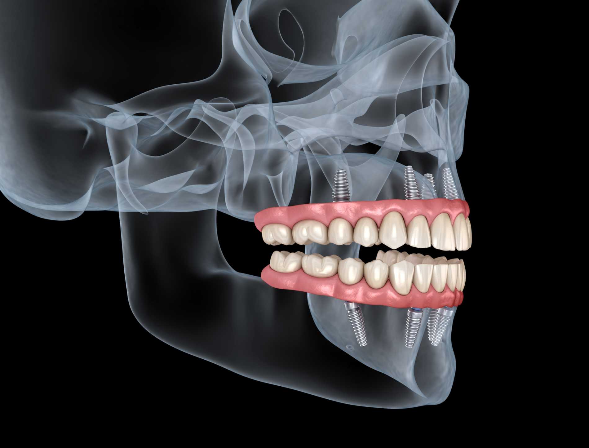all-on-4-dental-implants