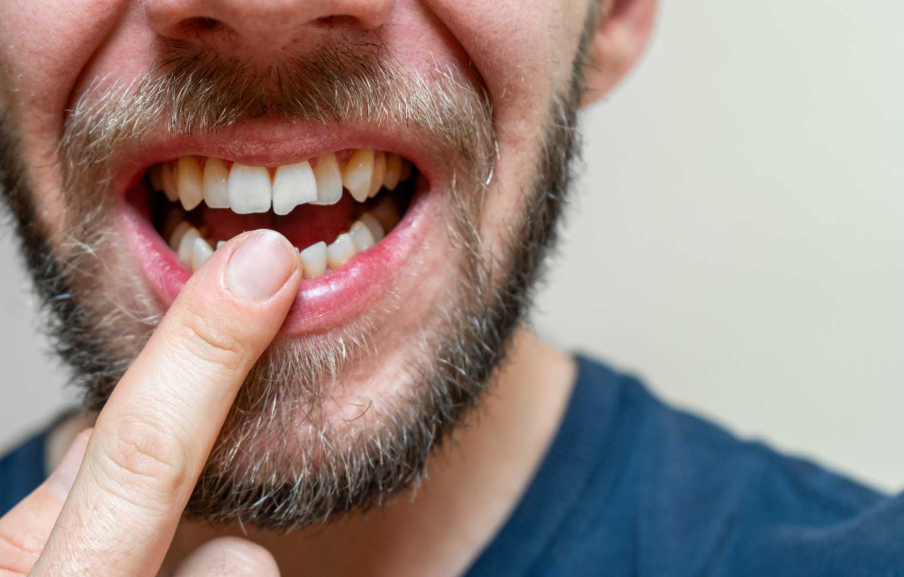 Broken tooth treatment concerns in Parker, CO