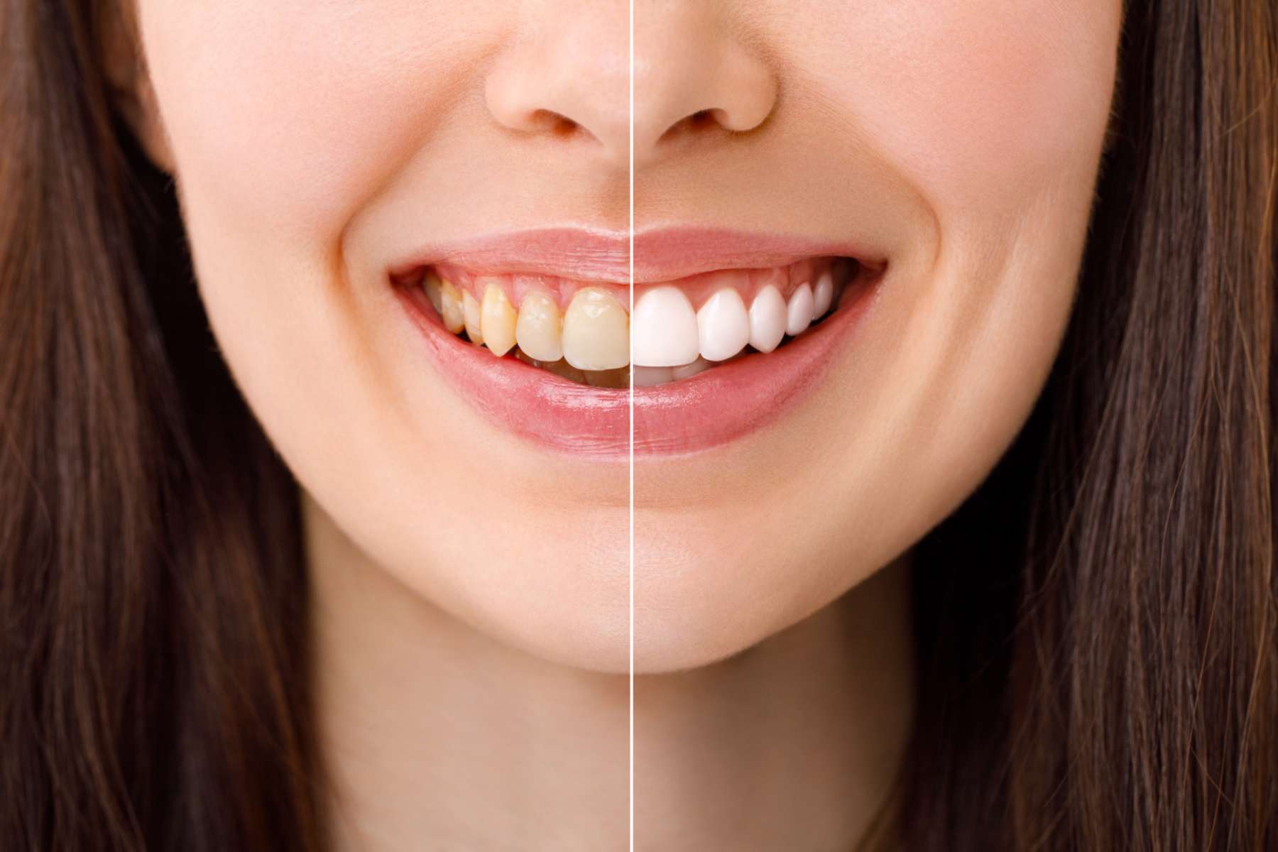 Comparison of discolored teeth and brighter teeth after whitening