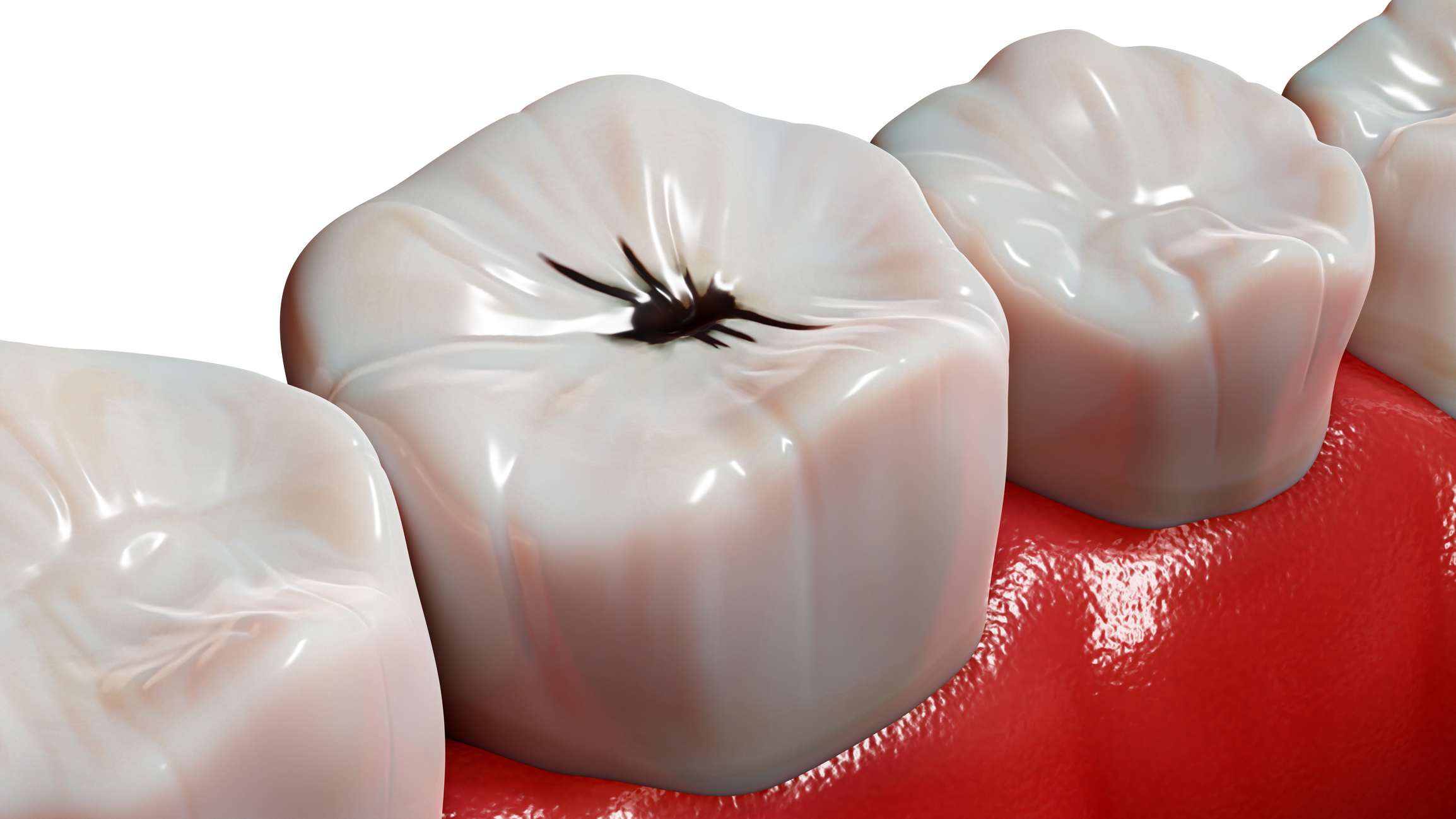 Dark spot on molar indicating tooth decay in Parker, CO